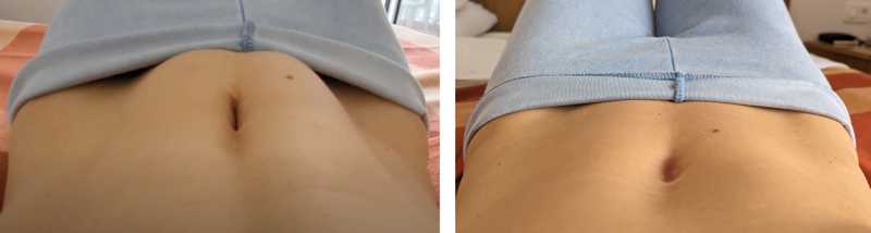 Two photos of the same abdomen bulging or not bulging